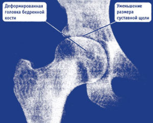 Артроз на рентгене